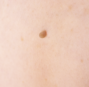 Blemish removal, skin tag removal using advanced eelectrolysis