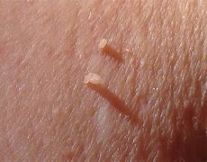 This picture shows skin tags which can be safely and effectively removed using advanced electrolysis