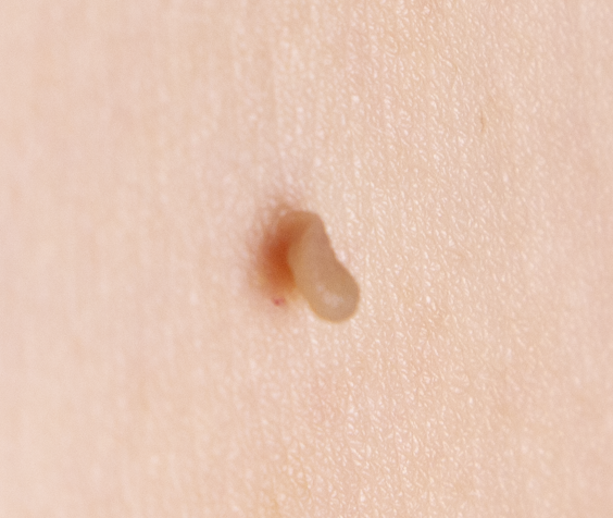 Skin Tags removal using advanced electrolysis