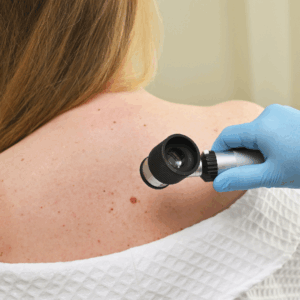 A dermatoscope being used to examine a mole on the back during a professional skin check before mole reduction treatment.