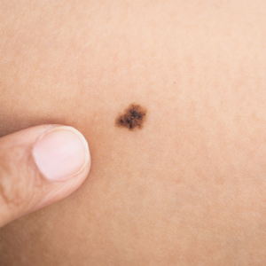 mole skin check. Noticing a mole and unsure what to do? Learn how a professional skin check can offer reassurance and help you decide the next step calmly.